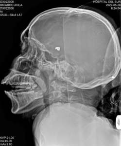 X-ray examination of the skull of Ricardo Ávila on May 26, 2022.