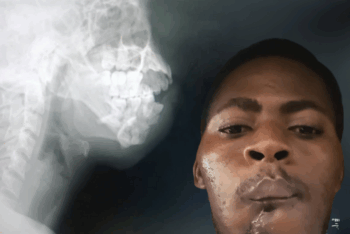Haitian journalist Jocelyn Justin with a visible injury on the right side of his jaw. A medical X-ray of his skull and jaw is visible in the background.