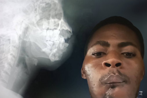Haitian journalist Jocelyn Justin with a visible injury on the right side of his jaw. A medical X-ray of his skull and jaw is visible in the background.