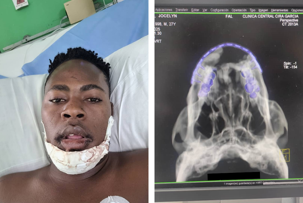 Haitian journalist Jocelyn Justin with a bandaged jaw lying in a hospital bed, next to an image of his skull CT scan.